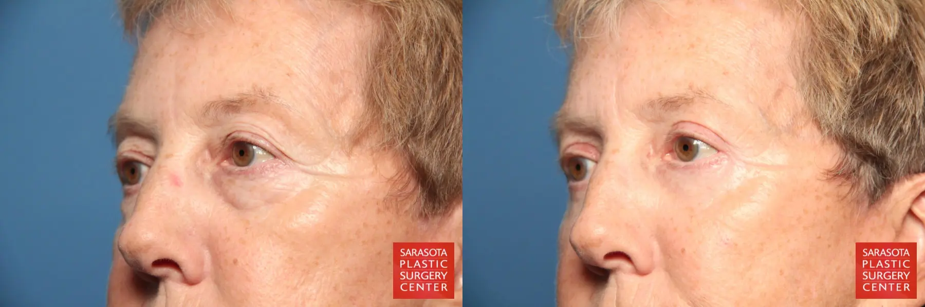 Eyelid Lift: Patient 22 - Before and After 4