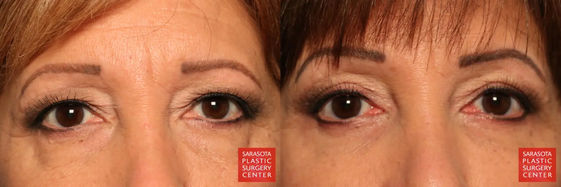 Eyelid Lift: Patient 10 - Before and After  