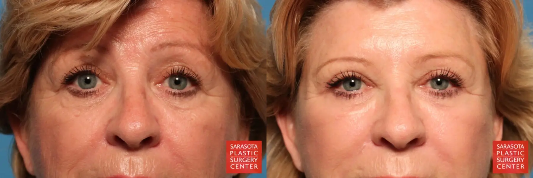 Eyelid Lift: Patient 18 - Before and After  