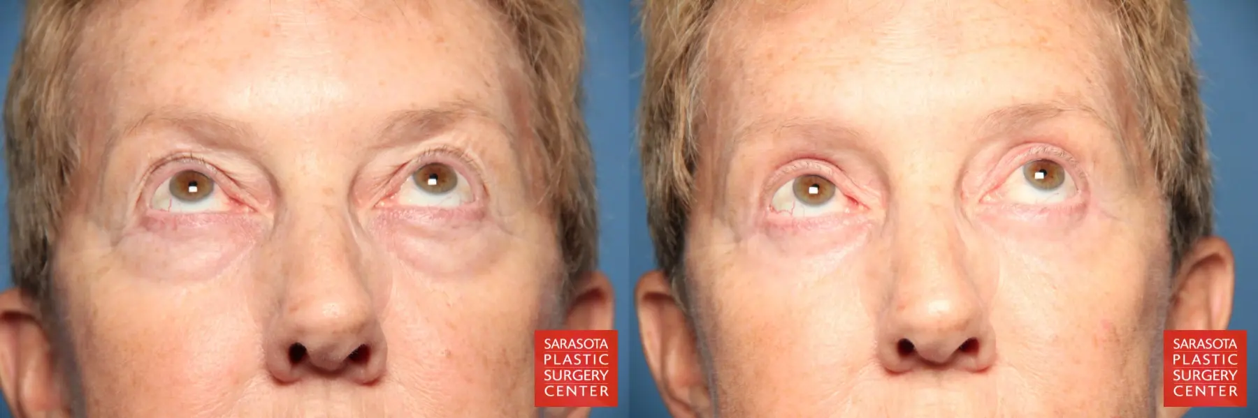 Eyelid Lift: Patient 22 - Before and After 3