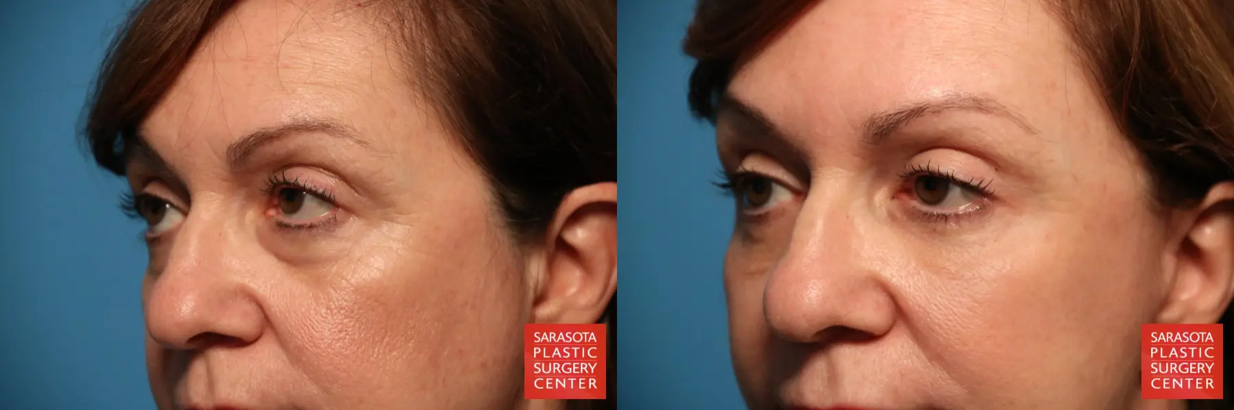 Eyelid Lift: Patient 31 - Before and After 3