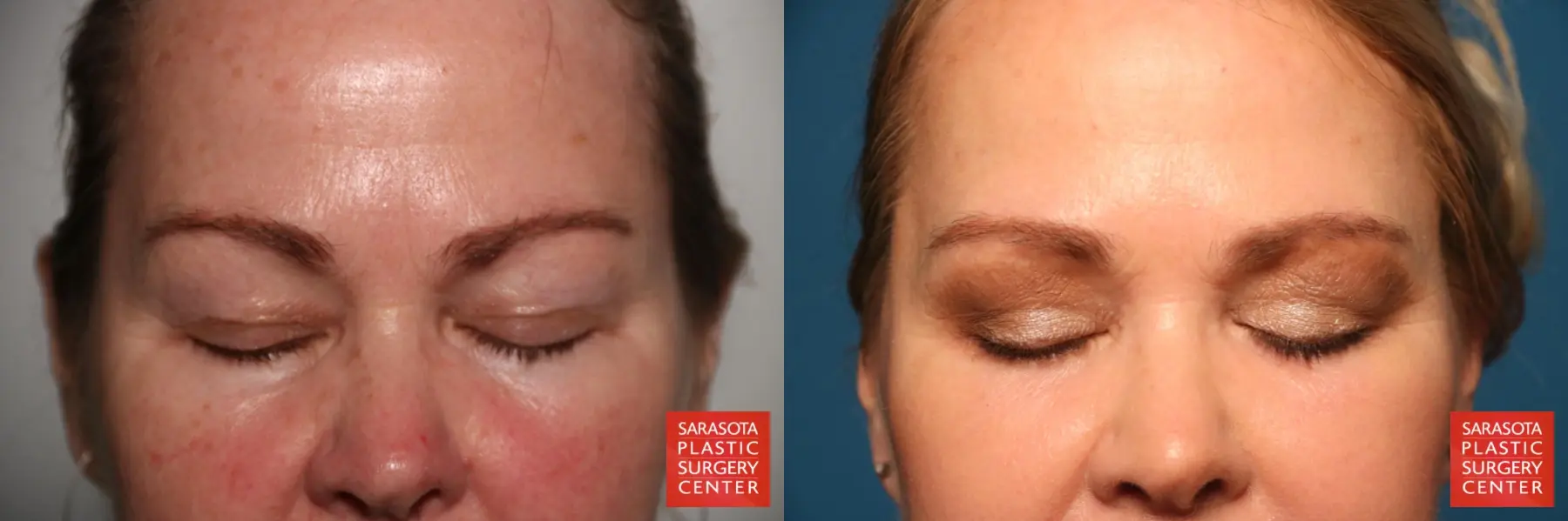 Eyelid Lift: Patient 44 - Before and After 2