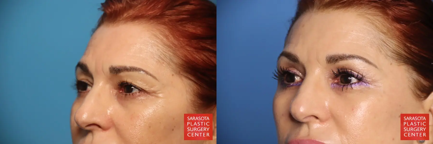 Eyelid Lift: Patient 48 - Before and After 4