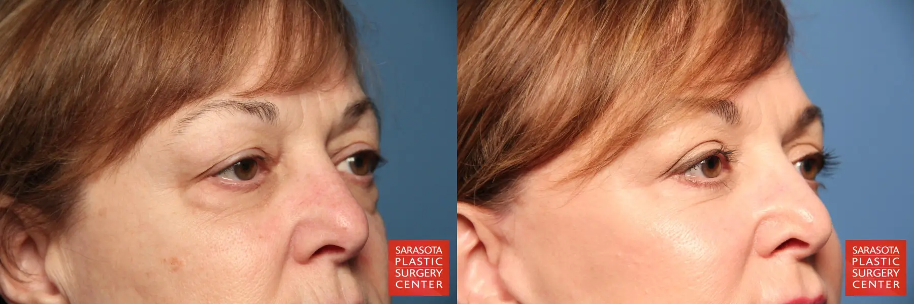 Eyelid Lift: Patient 70 - Before and After 4