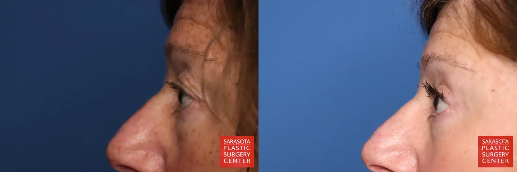 Eyelid Lift: Patient 58 - Before and After 5