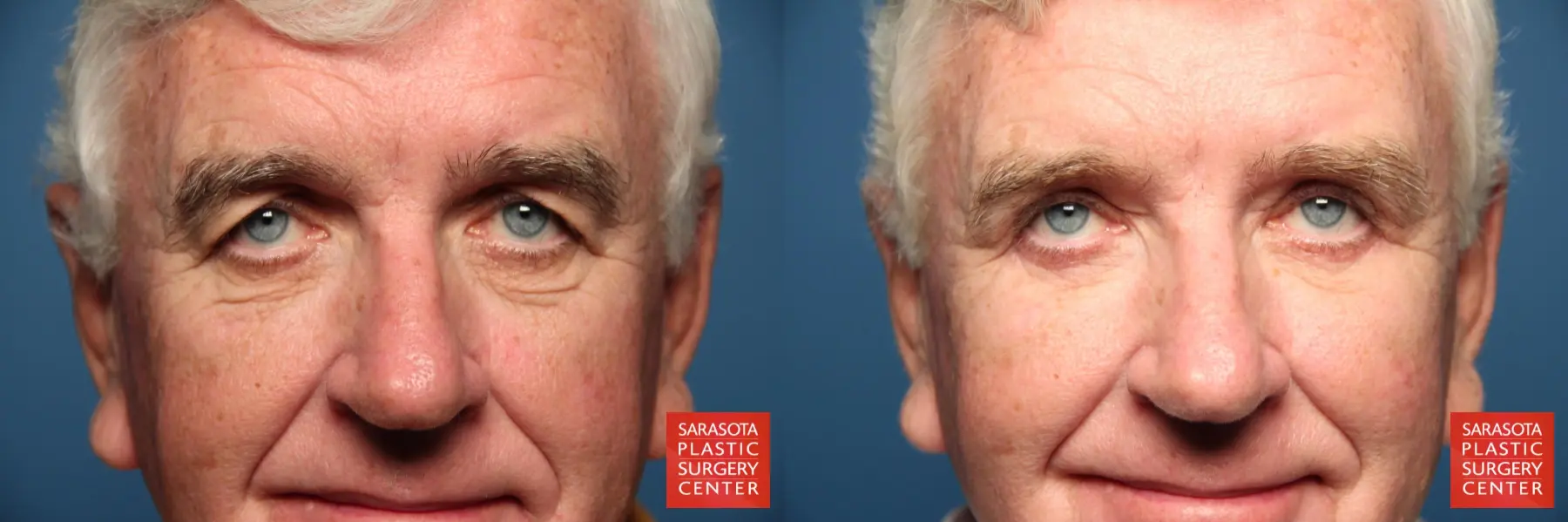 Eyelid-lift-for-men: Patient 1 - Before and After  