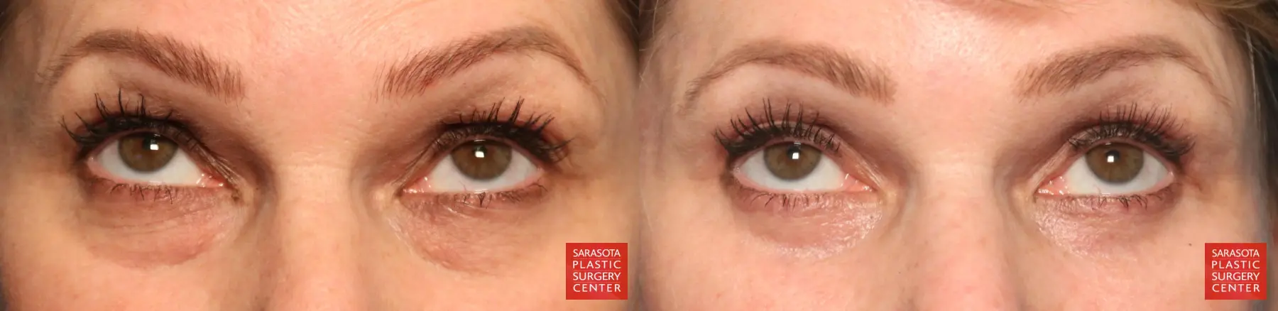 Eyelid Lift: Patient 53 - Before and After 2