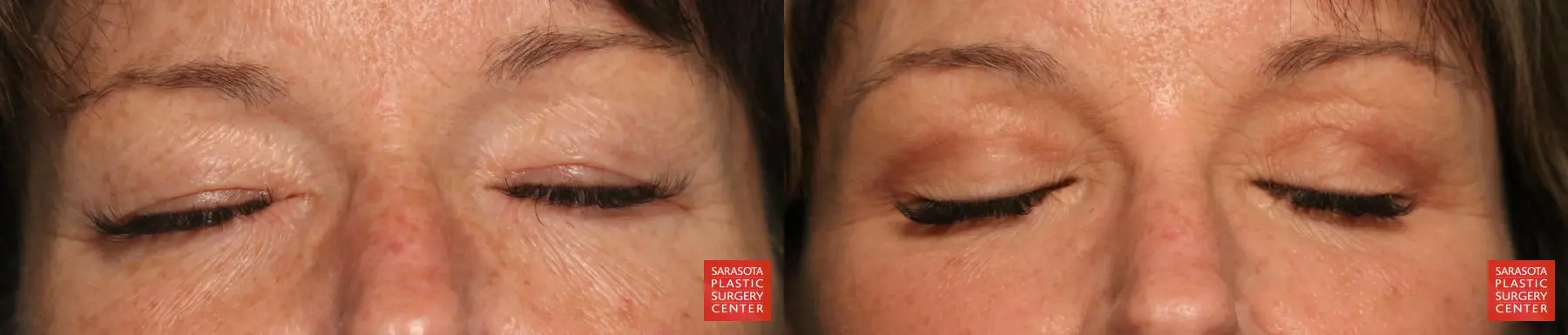 Eyelid Lift: Patient 67 - Before and After 2