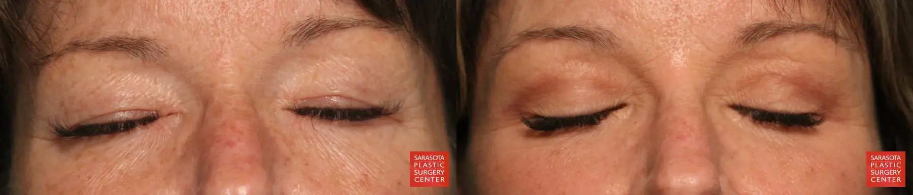 Eyelid Lift: Patient 69 - Before and After 2