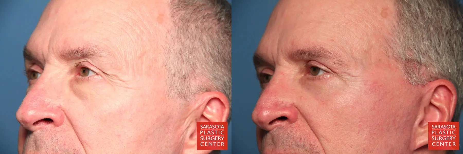 Eyelid Lift For Men: Patient 2 - Before and After 4