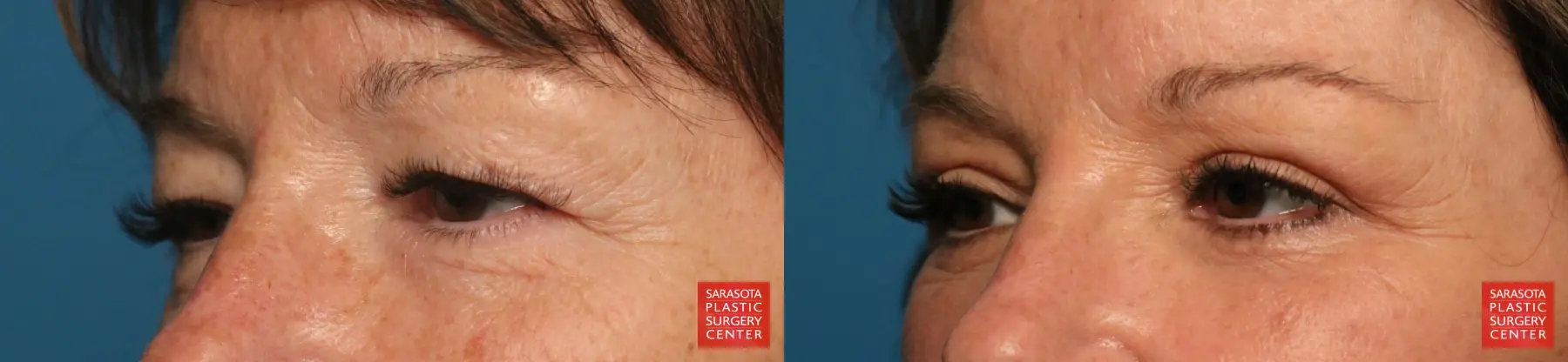 Eyelid Lift: Patient 69 - Before and After 3