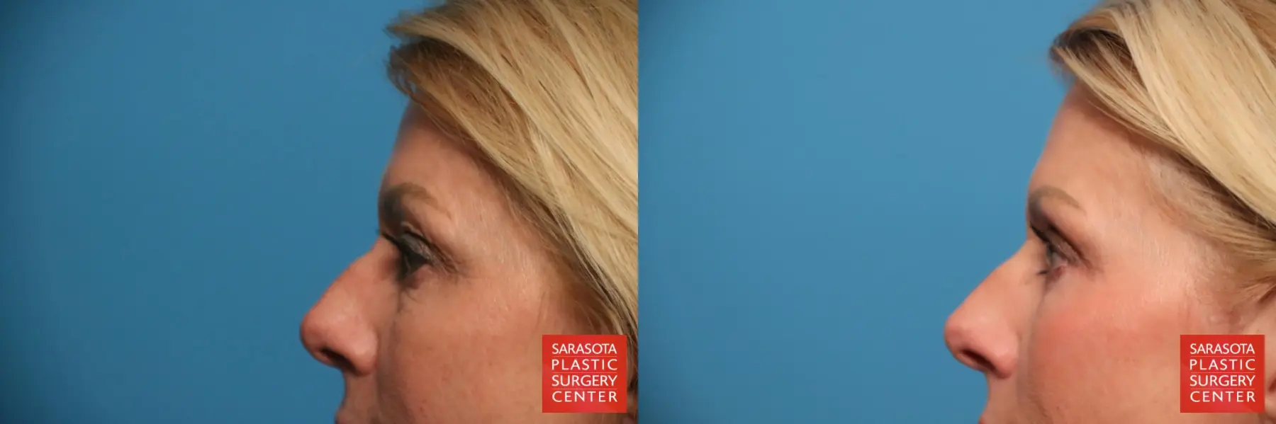 Eyelid Lift: Patient 59 - Before and After 3