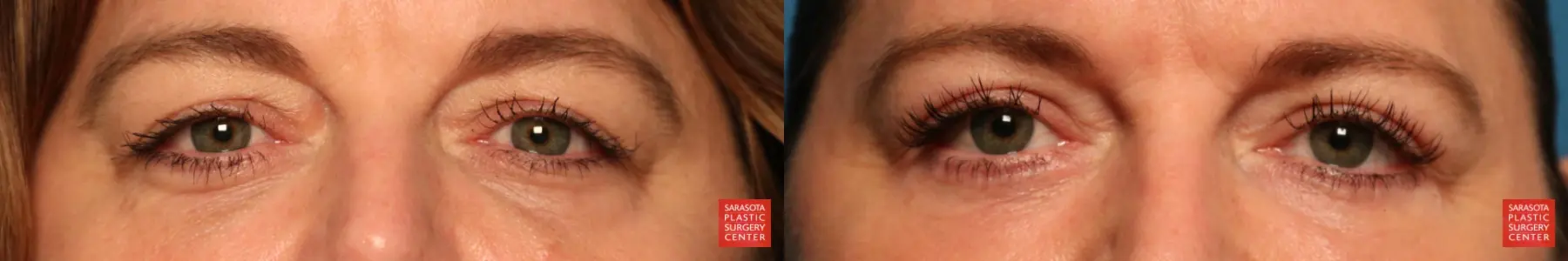 Eyelid Lift: Patient 6 - Before and After  