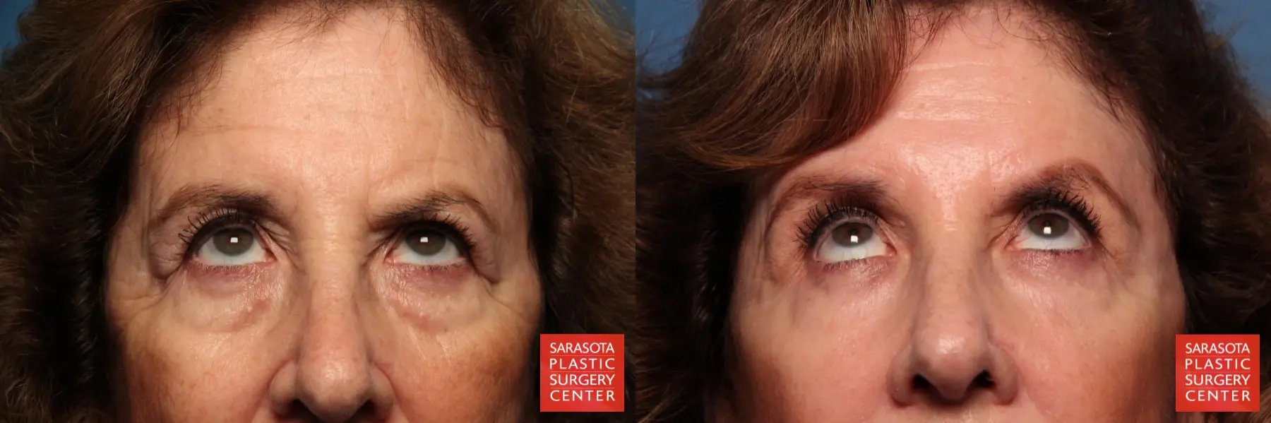 Eyelid Lift: Patient 42 - Before and After 3