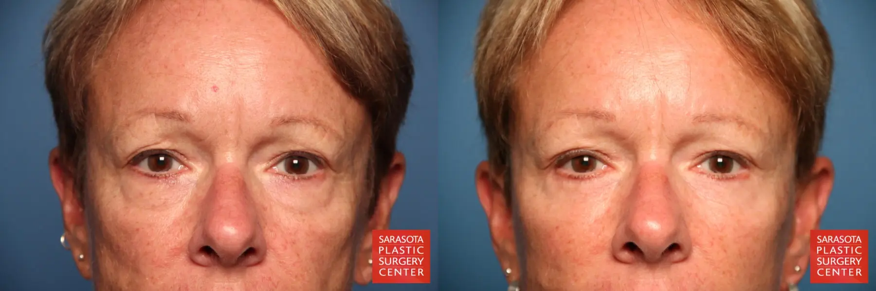 Eyelid Lift: Patient 18 - Before and After 1