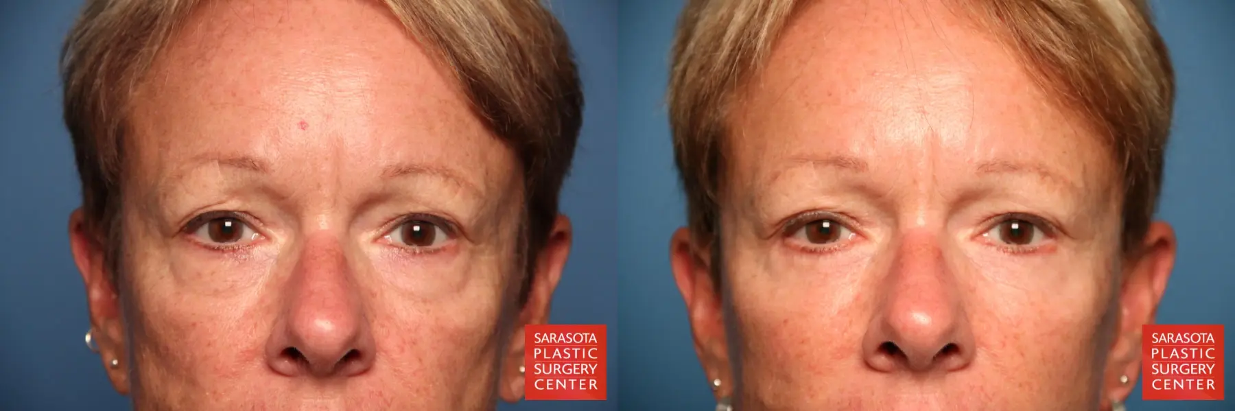 Eyelid Lift: Patient 20 - Before and After  