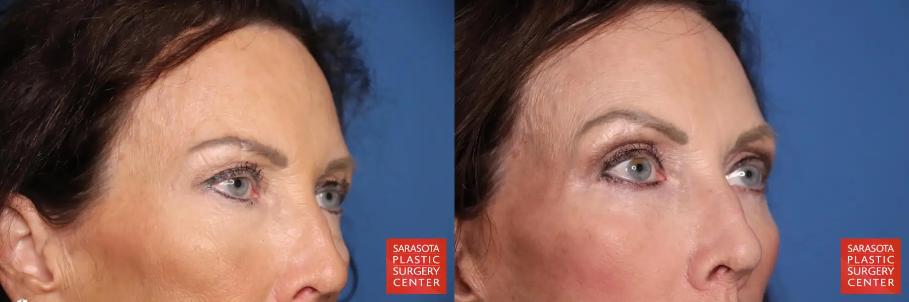 Eyelid Lift: Patient 64 - Before and After 4
