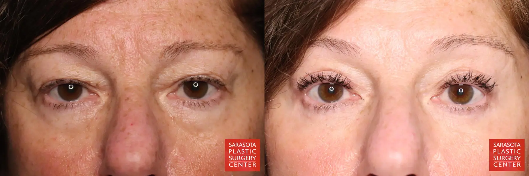 Eyelid Lift: Patient 58 - Before and After 1