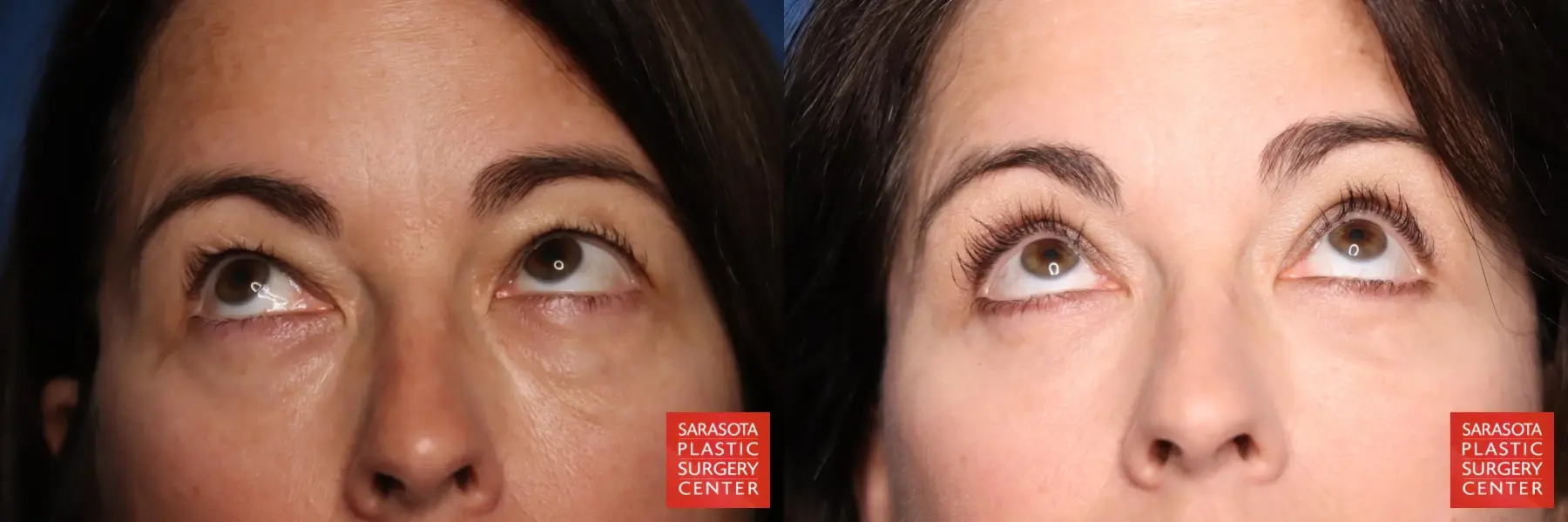Eyelid Lift: Patient 3 - Before and After 2