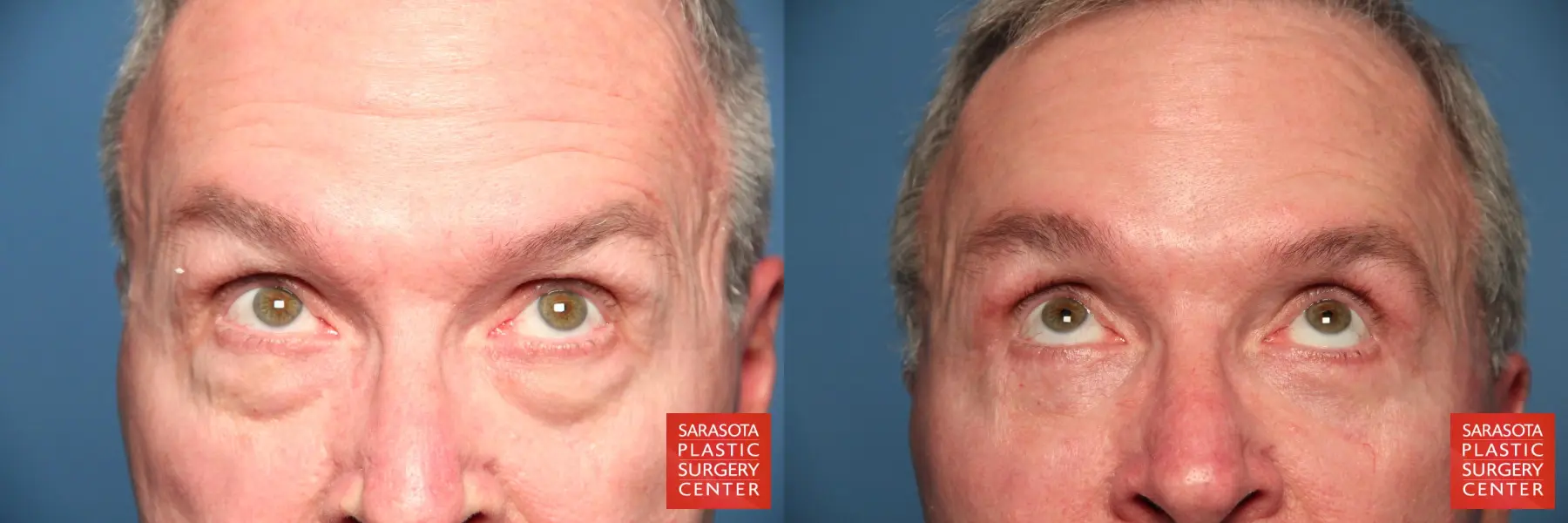 Eyelid Lift For Men Revision: Patient 1 - Before and After 2