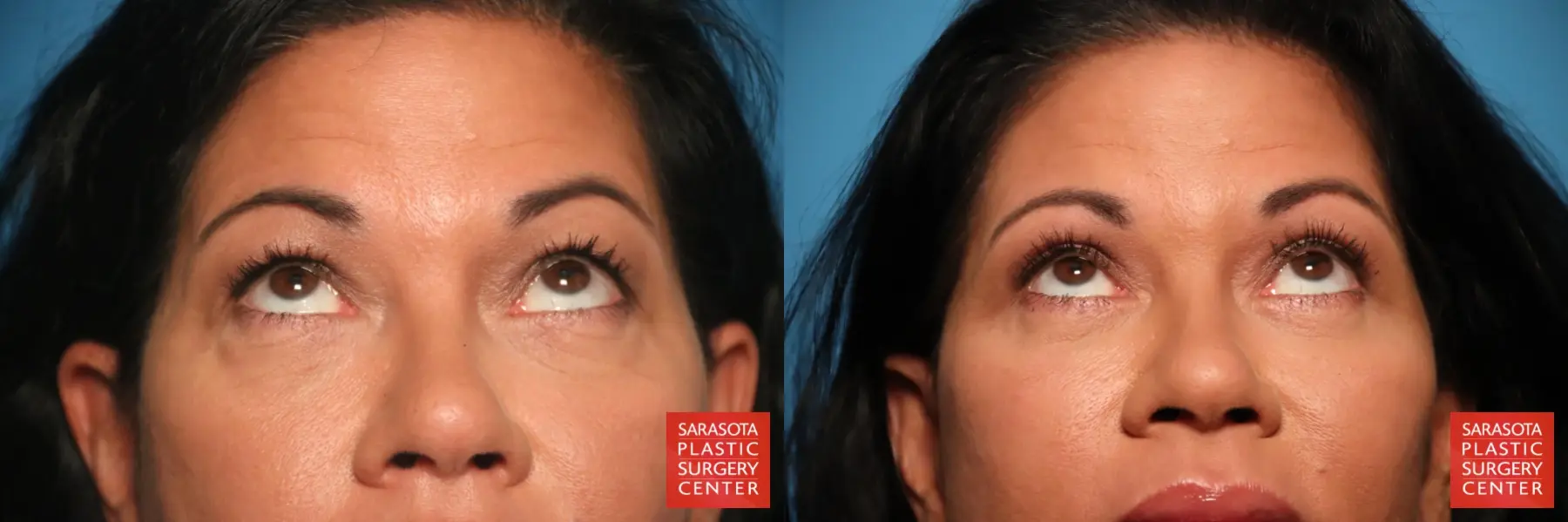 Eyelid Lift: Patient 47 - Before and After 2