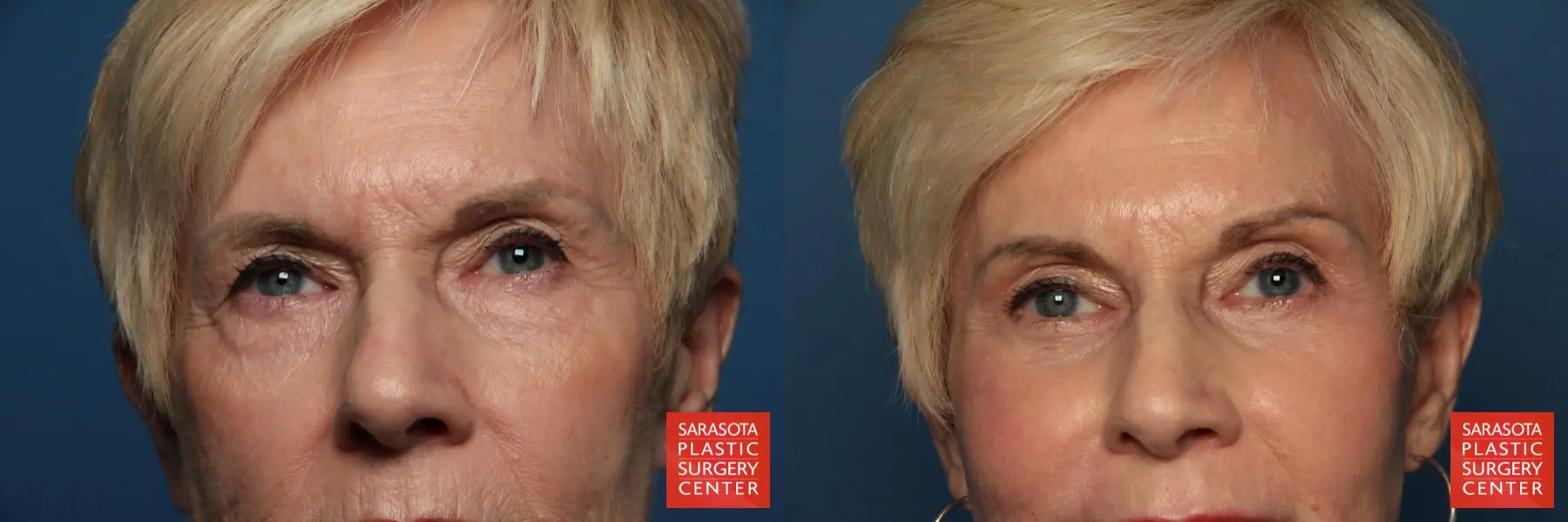 Eyelid Lift: Patient 30 - Before and After 1