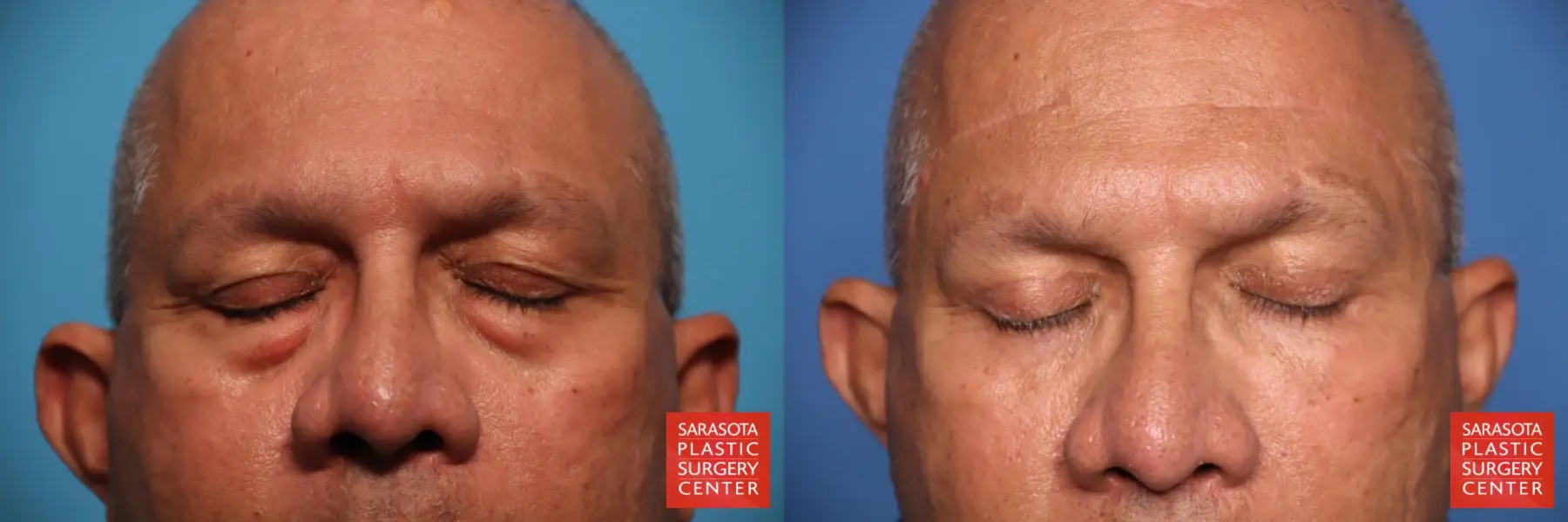 Eyelid Lift: Patient 56 - Before and After 3