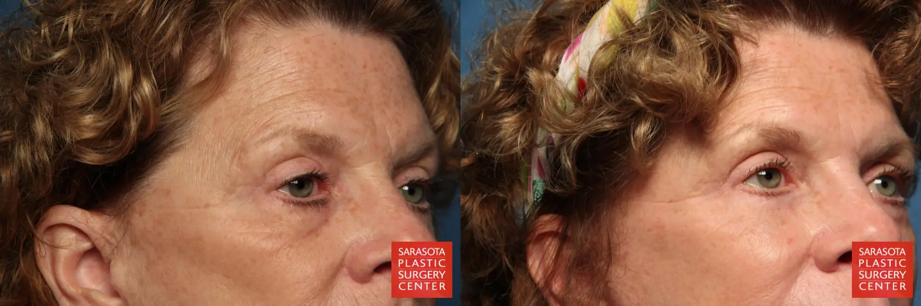 Eyelid Lift: Patient 25 - Before and After 2