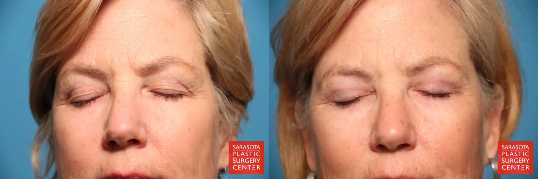 Eyelid Lift: Patient 50 - Before and After 3