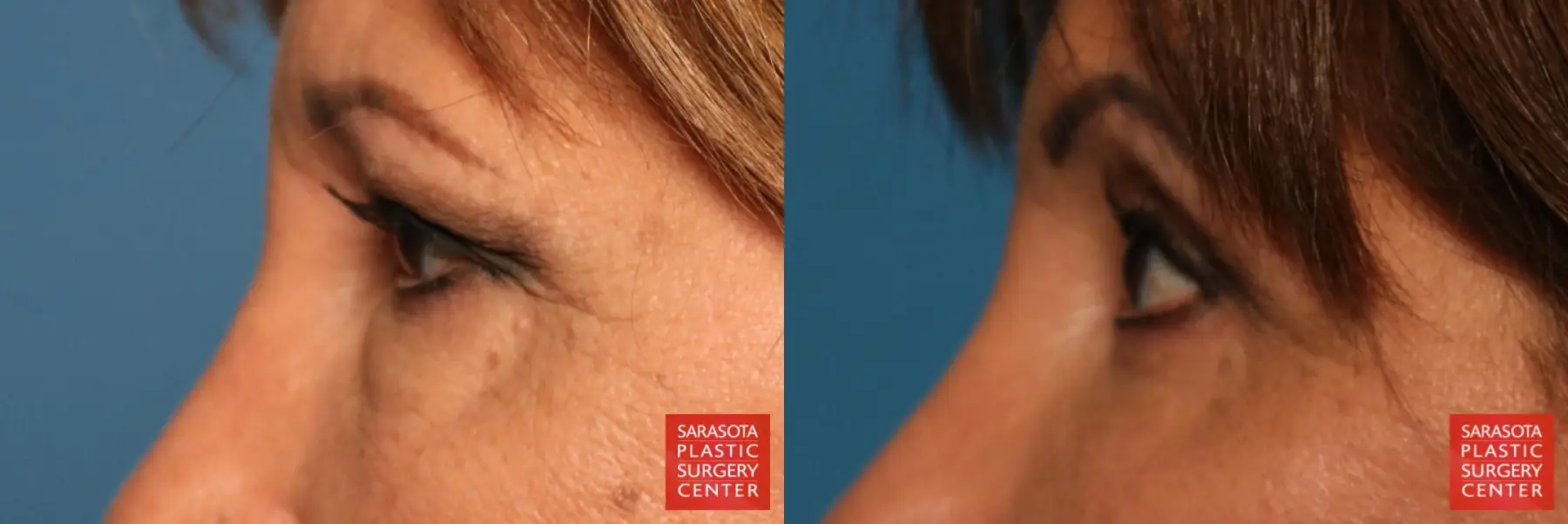 Eyelid Lift: Patient 9 - Before and After 5