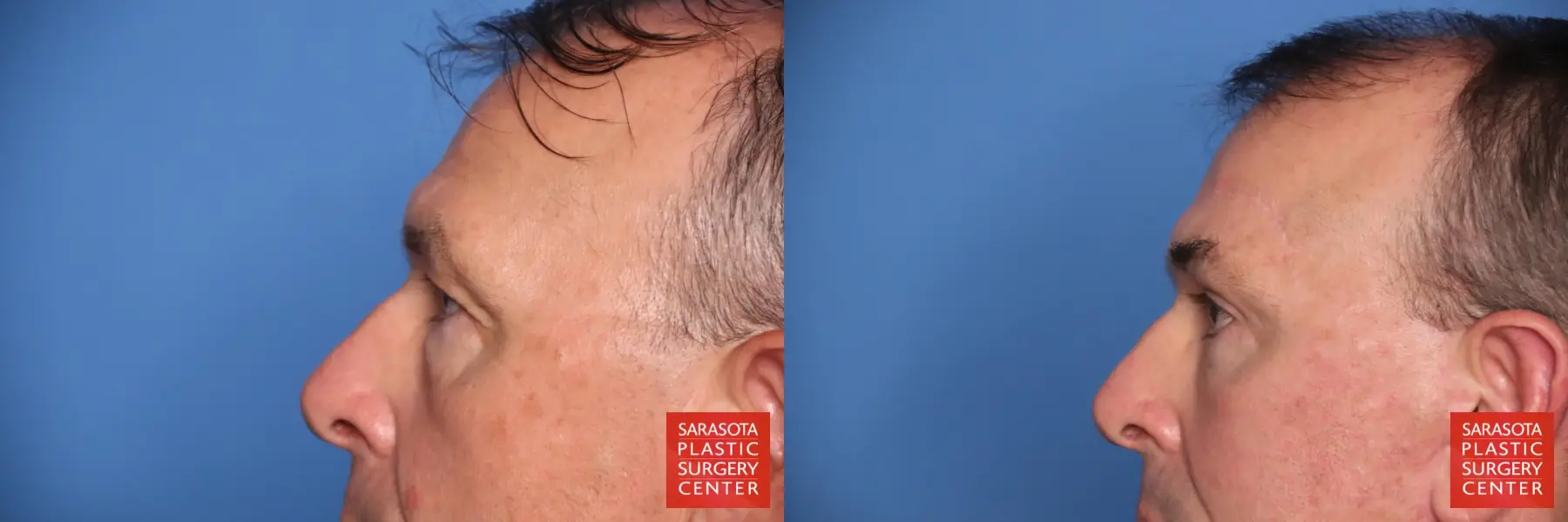 Eyelid Lift: Patient 61 - Before and After 3