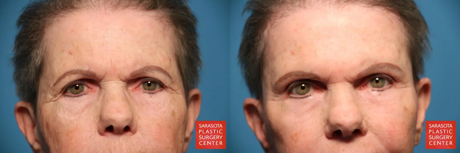 Eyelid Lift: Patient 30 - Before and After  