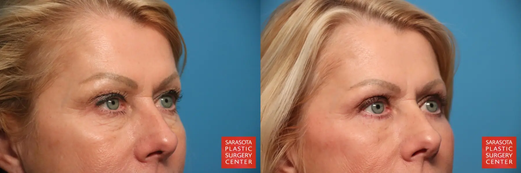 Eyelid Lift: Patient 59 - Before and After 4