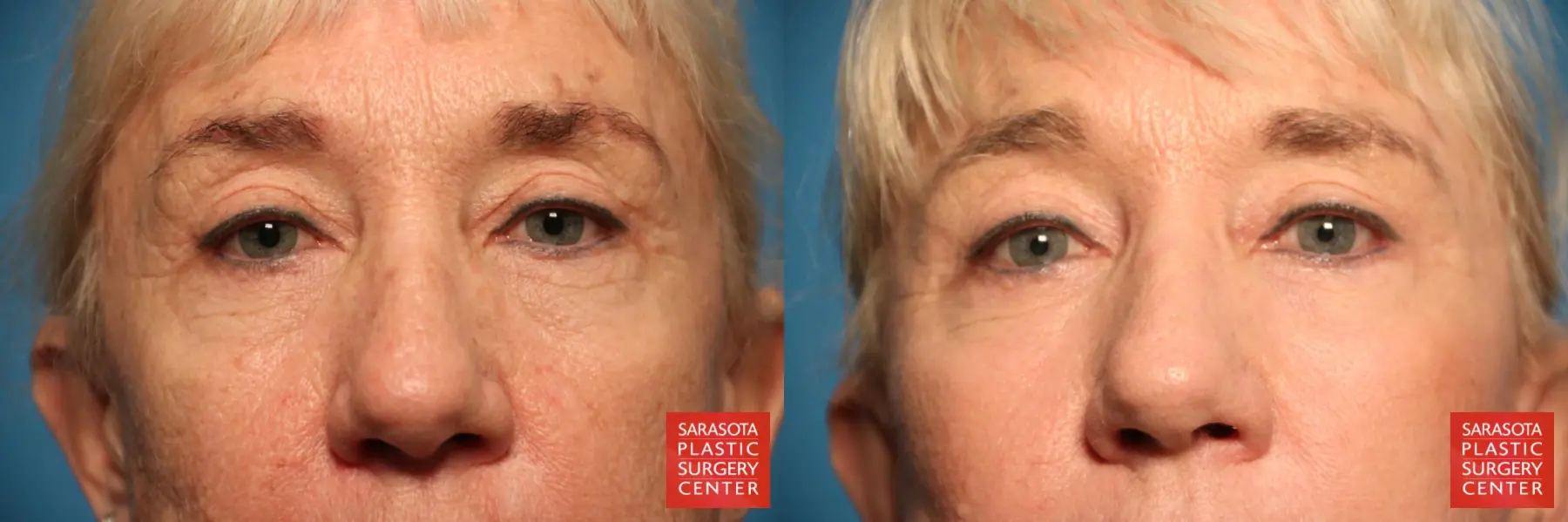 Eyelid Lift: Patient 45 - Before and After 1