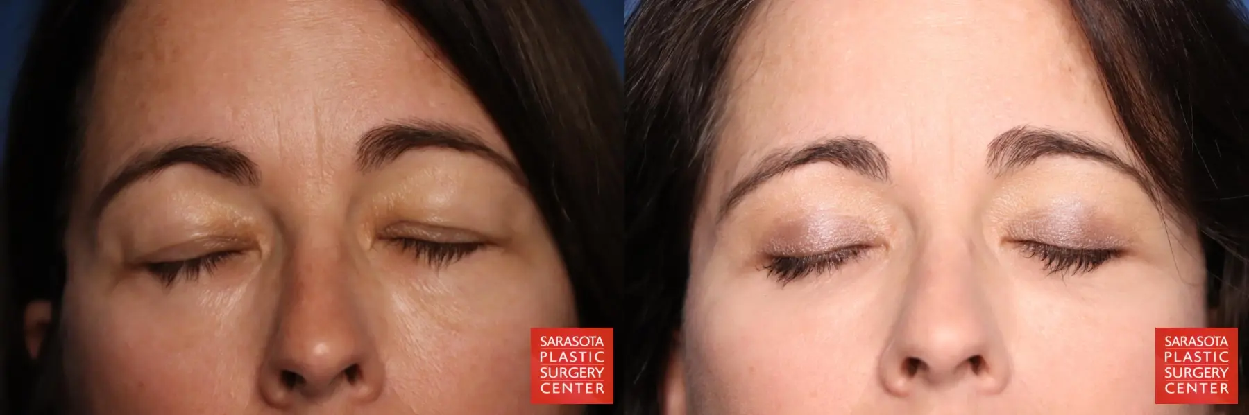 Eyelid Lift: Patient 3 - Before and After 3