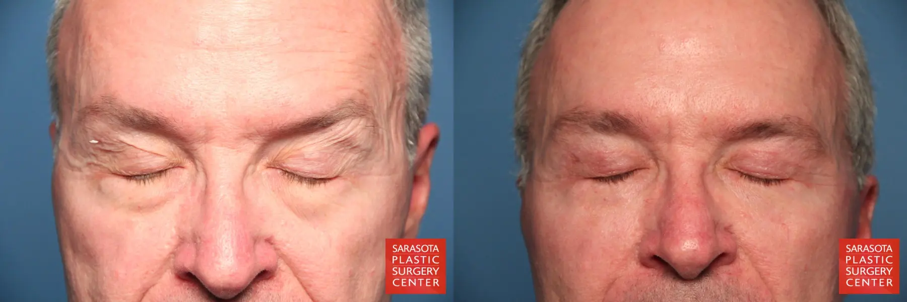 Eyelid Lift For Men Revision: Patient 1 - Before and After 3