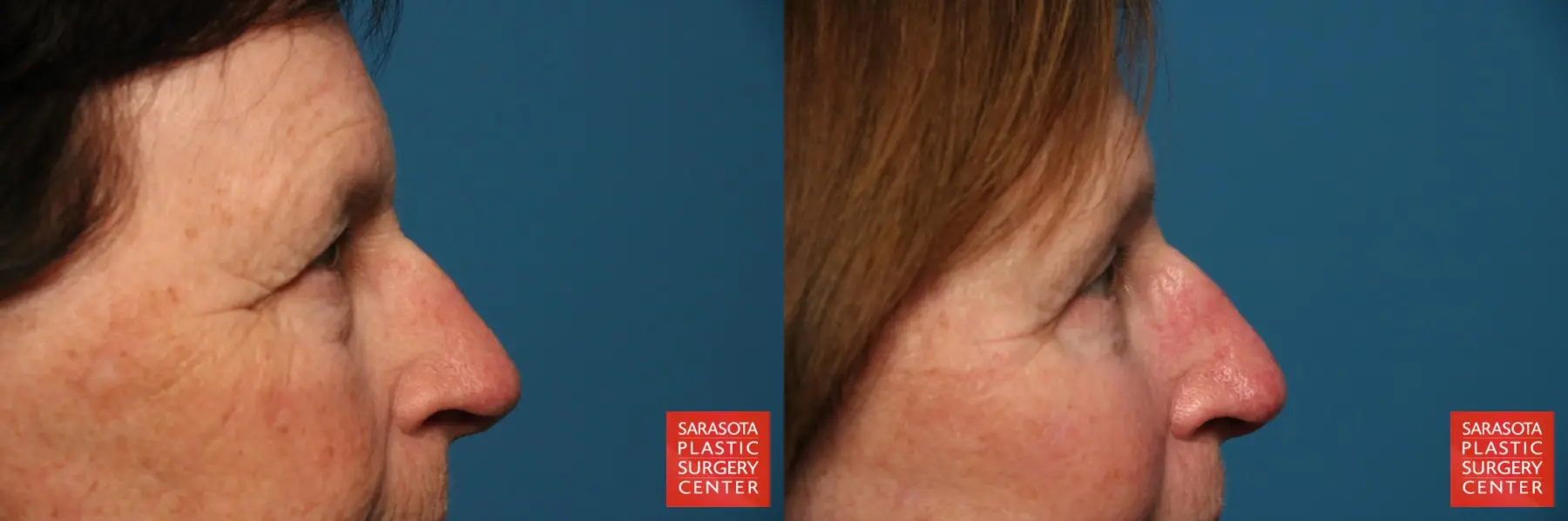 Eyelid Lift: Patient 51 - Before and After 5