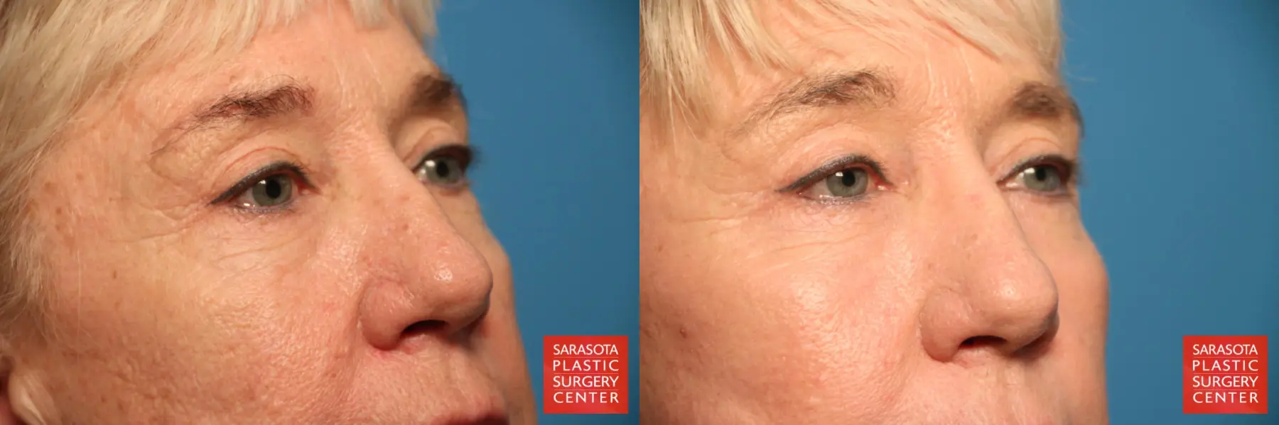 Eyelid Lift: Patient 45 - Before and After 2