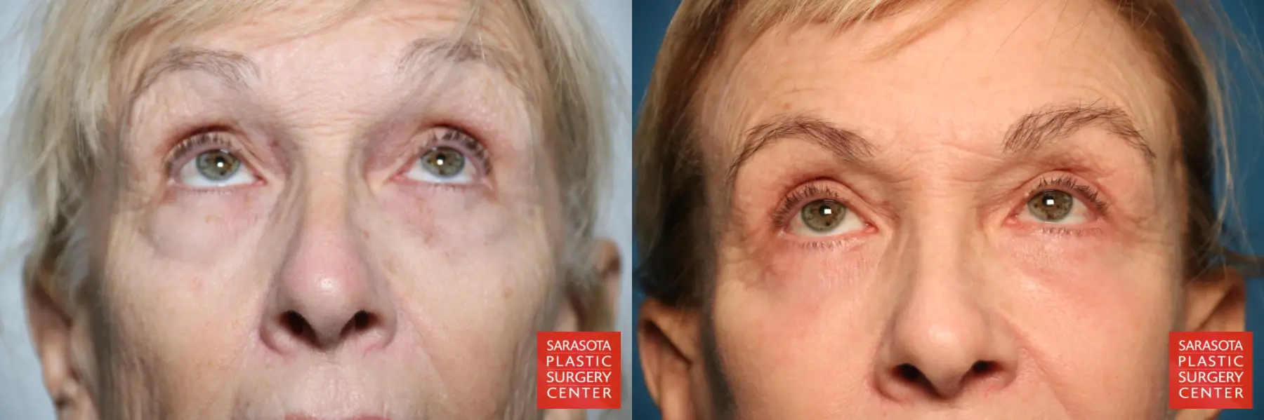 Eyelid Lift: Patient 43 - Before and After 2