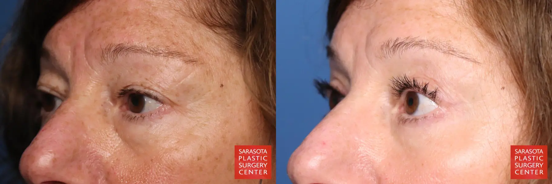 Eyelid Lift: Patient 58 - Before and After 4