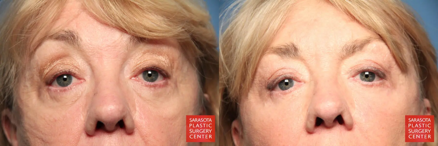 Eyelid Lift: Patient 24 - Before and After  