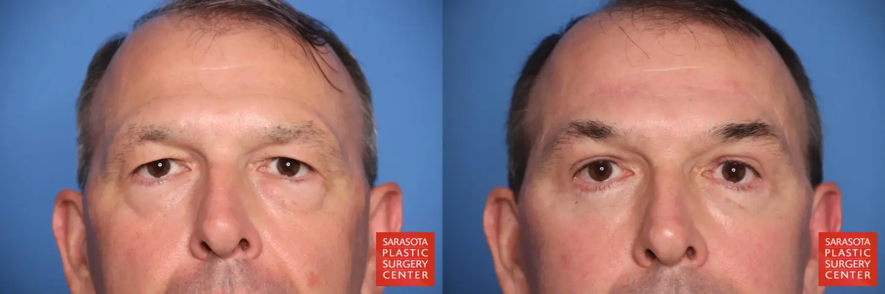 Eyelid Lift: Patient 61 - Before and After 1