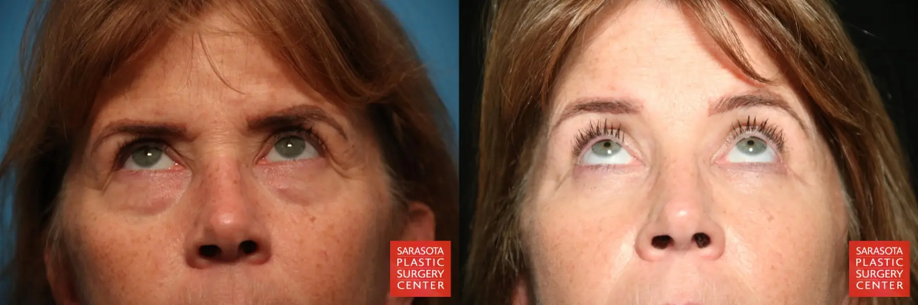 Eyelid Lift: Patient 37 - Before and After 2