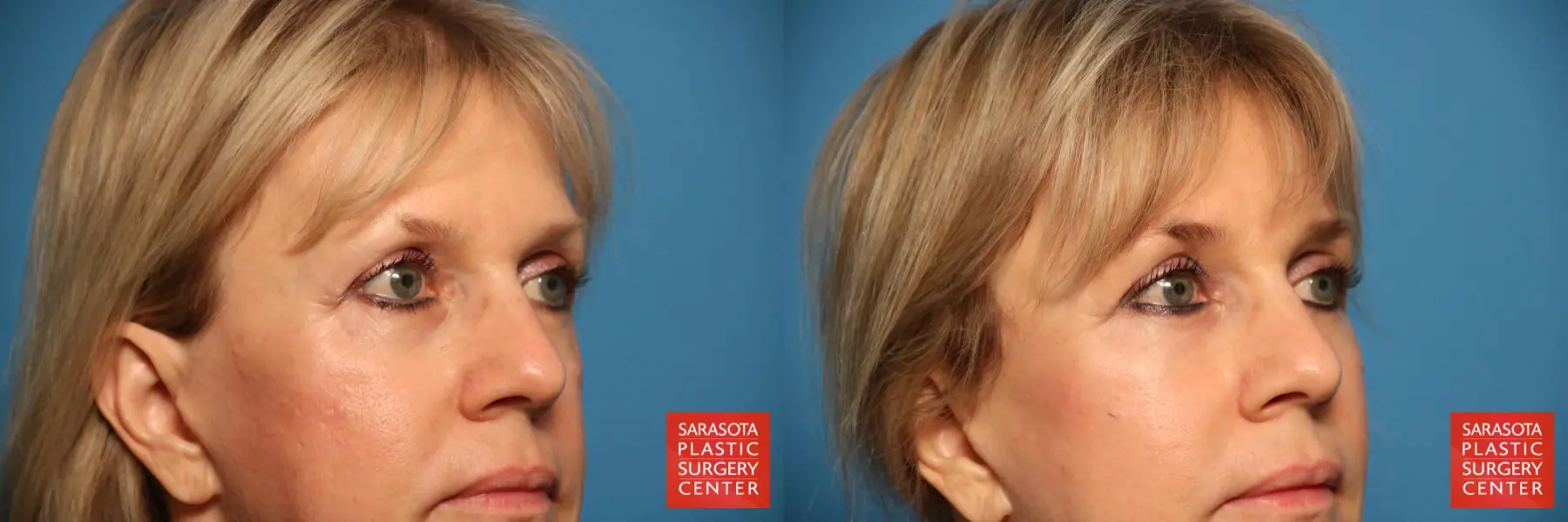 Eyelid Lift: Patient 7 - Before and After 6