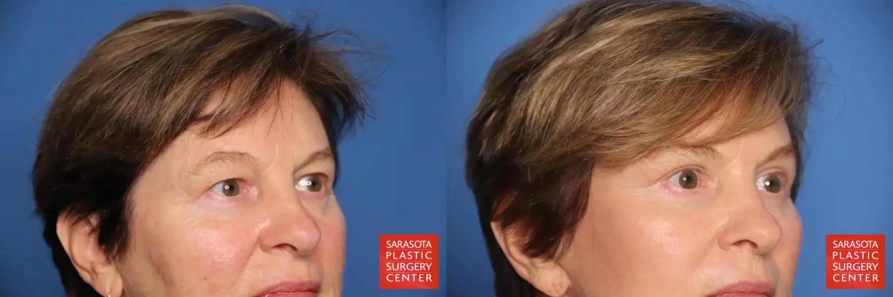 Eyelid Lift: Patient 67 - Before and After 4