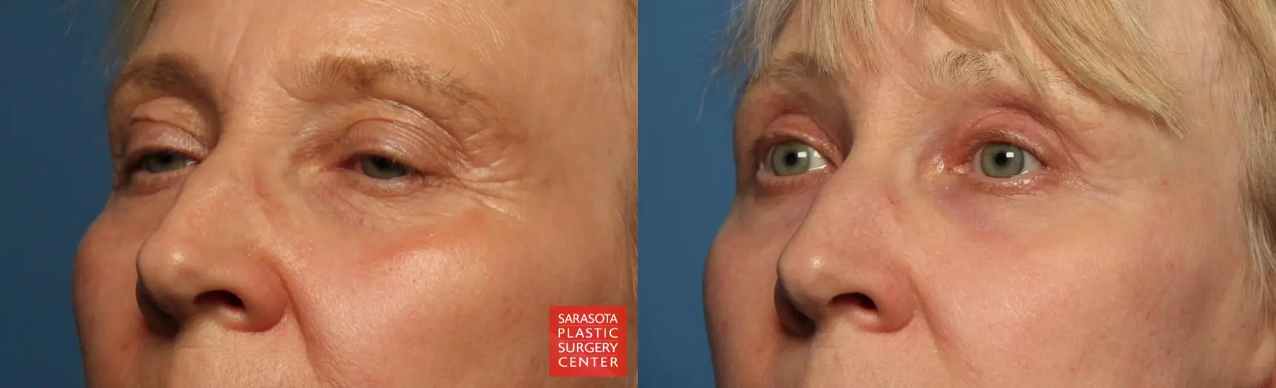 Eyelid Lift: Patient 55 - Before and After 2