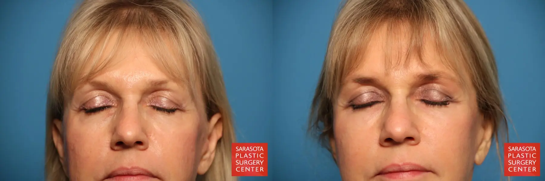Eyelid Lift: Patient 7 - Before and After 2