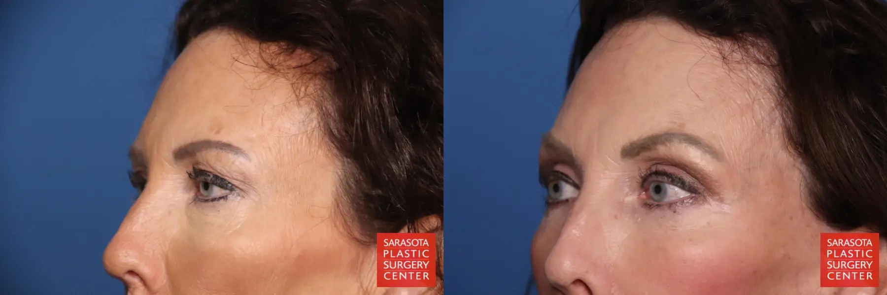 Eyelid Lift: Patient 64 - Before and After 2