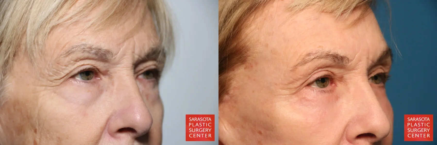Eyelid Lift: Patient 43 - Before and After 3