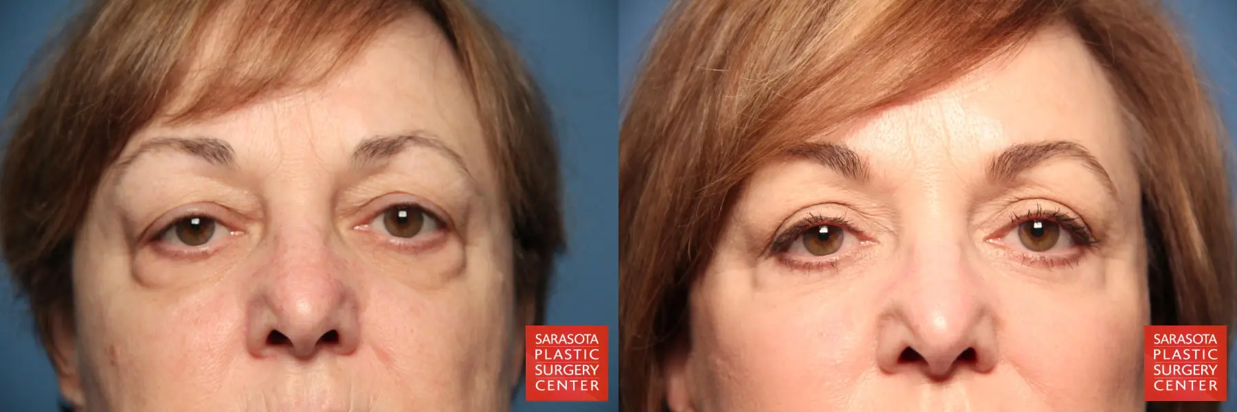 Eyelid Lift: Patient 70 - Before and After 1